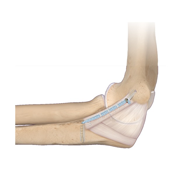 ligamento colateral lateral del codo